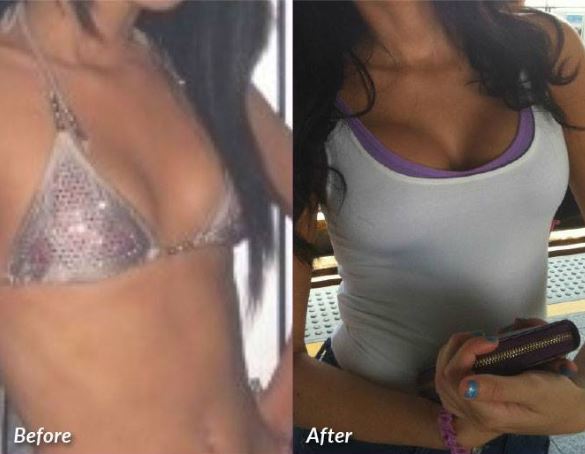 Breast Augmentation Before & After #4