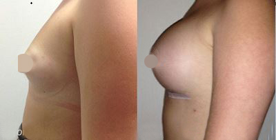 Breast Augmentation Before & After #19