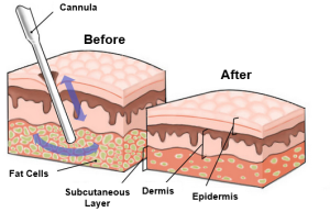 Liposuction