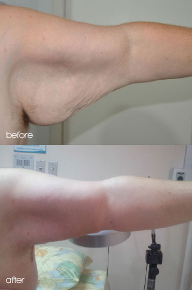 arm lift surgery arm reduction in thailand cosmeditour arm lift surgery arm reduction in thailand cosmeditour