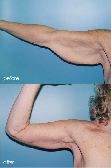 arm lift surgery arm reduction in thailand cosmeditour arm lift surgery arm reduction in thailand cosmeditour