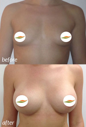 Breast Augmentation Before & After #10