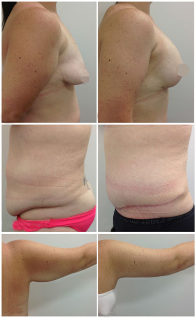 Breast Augmentation and Breast Lift with Arm Lift #6