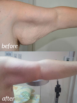 Arm Lift Before and After #6