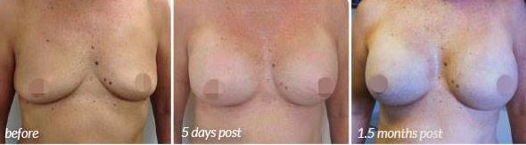 Breast Augmentation Before & After #28