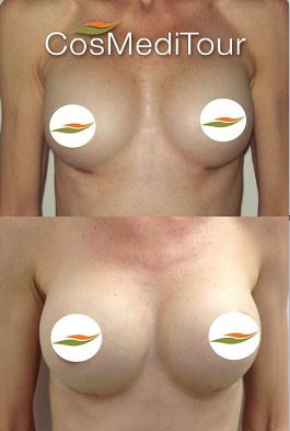 Breast Revision Before and After #4