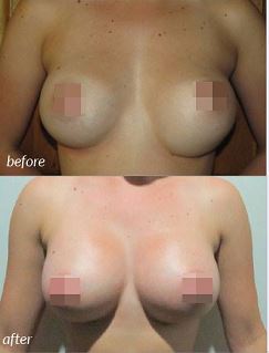 Breast Revision Before and After #1