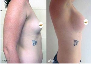 Breast Augmentation Before & After #16