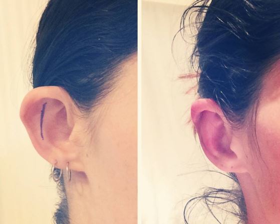 Ear Pinning Before and After #1
