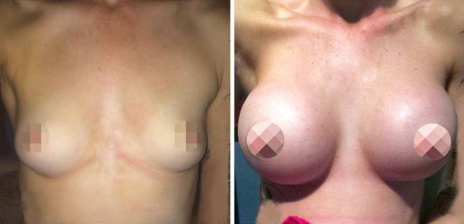 Breast Augmentation CosMediTour