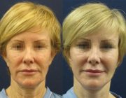 Dr. Seree Face and Neck Lift