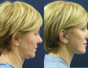 Dr. Seree Face and Neck Lift
