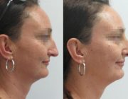 Dr. Seree Rhinoplasty Before & After Side Profile