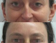 Dr. Seree Rhinoplasty Before & After Front Profile