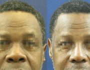 Dr. Seree Open Rhinoplasty, narrowing of the nasal bridge & nostrils