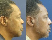Dr. Seree Open Rhinoplasty, narrowing of the nasal bridge