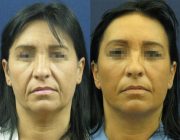 Dr. Seree Face Lift Before & 2 Years Post Surgery