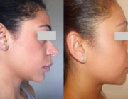 Rhinoplasty Dr. Seree, swelling still present.