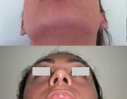 Dr. Seree Open Rhinoplasty, Nostril Reshaping