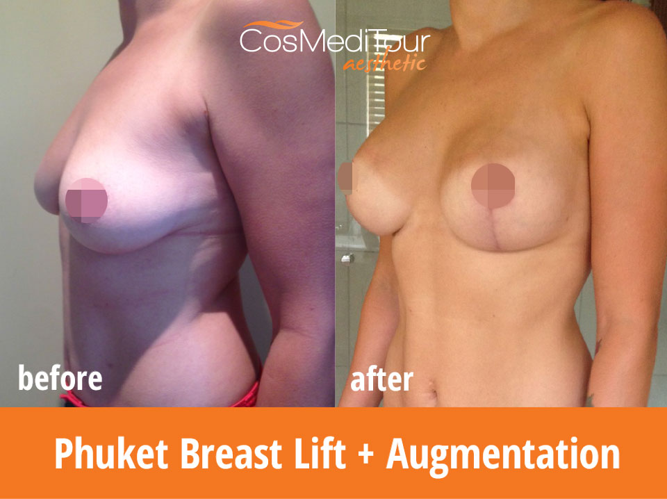 Breast Lift + Augmentation - 250cc, Round, Dual Plane Placement, Lollipop Incision