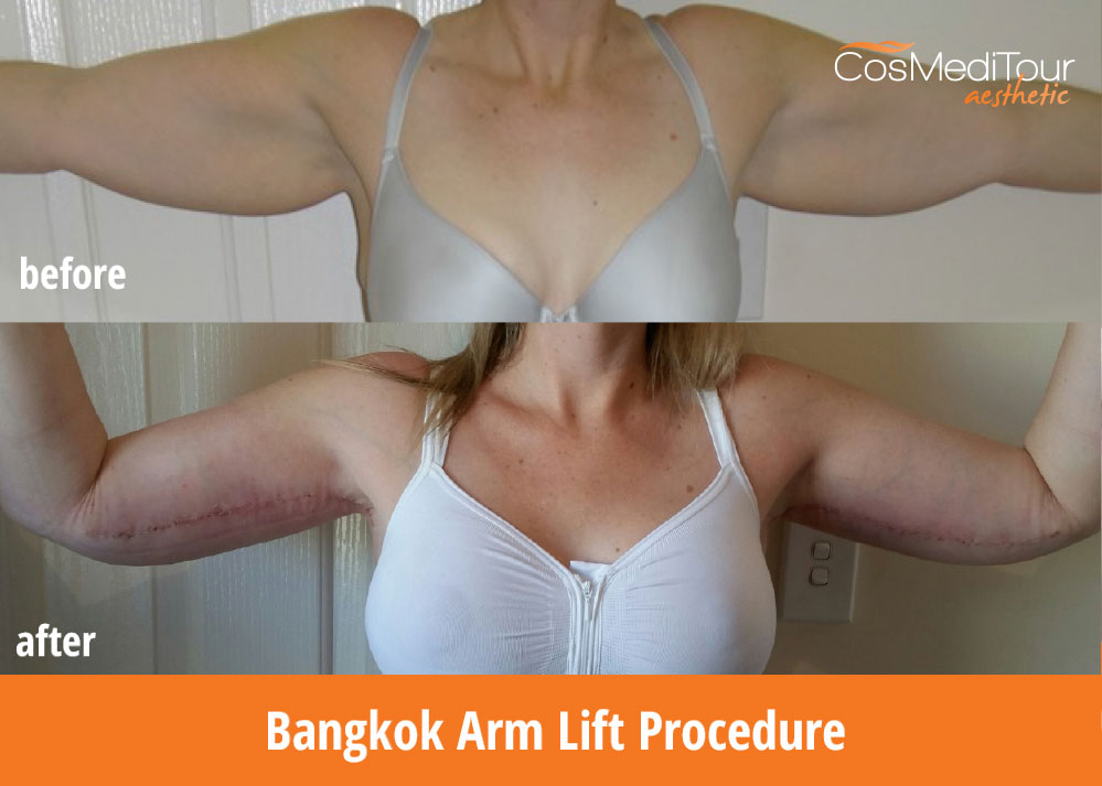 Breast Augmentation and Breast Lift with Arm Lift #7