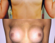 Breast Augmentation - 390cc, High Profile, Tear Drop, Dual Plane, Under the Breast Fold
