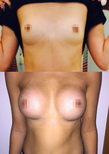 Breast Augmentation - 390cc, High Profile, Tear Drop, Dual Plane, Under the Breast Fold