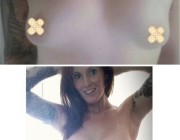 Breast Augmentation - 450cc, Round, High Profile, Over the Muscle