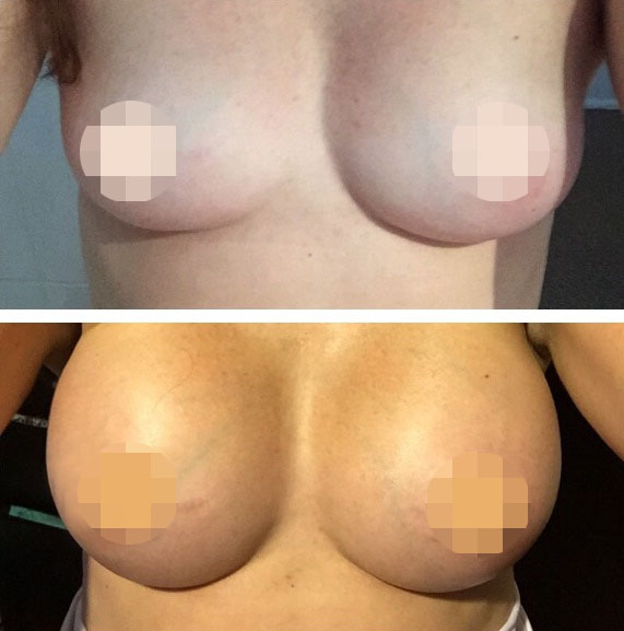 Breast Augmentation CosMediTour