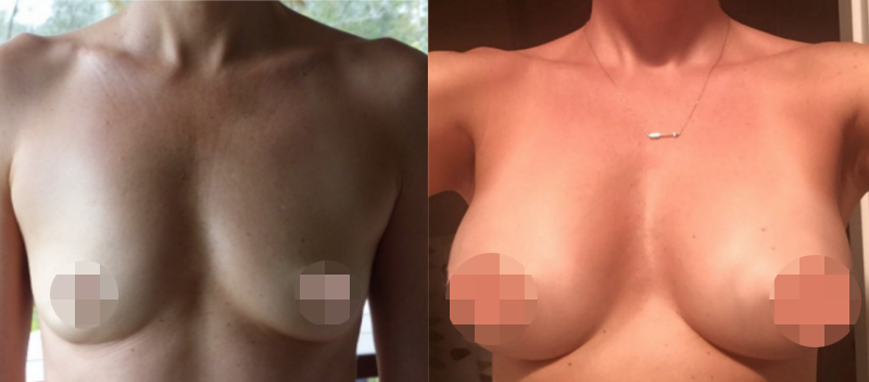 Breast Augmentation CosMediTour