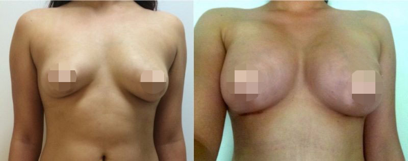 Breast Augmentation CosMediTour