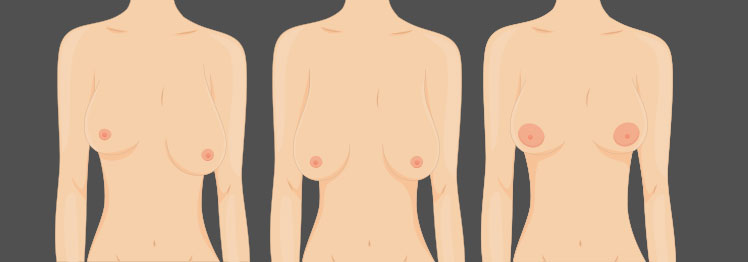 How to Correct Asymmetrical Breasts