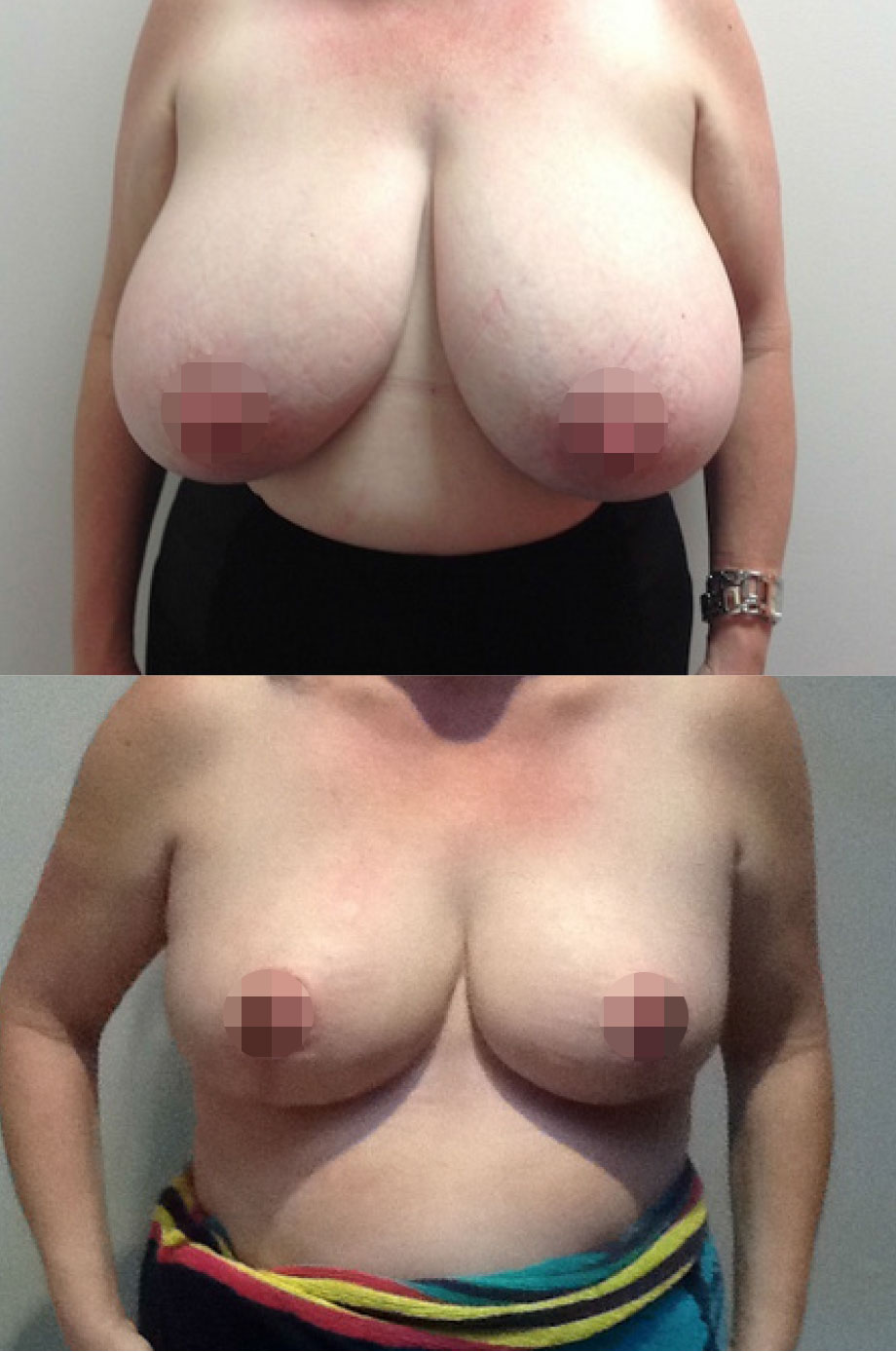 Breast Reduction Before & After #5