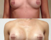 Breast Augmentation - 350cc, Moderate Plus Profile, Round, Under the Muscle, Under the Breast Fold.