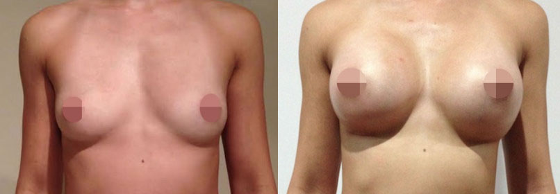 Breast Augmentation CosMediTour