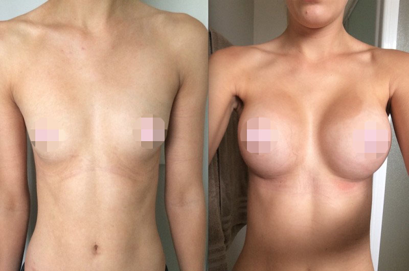 Breast Augmentation CosMediTour