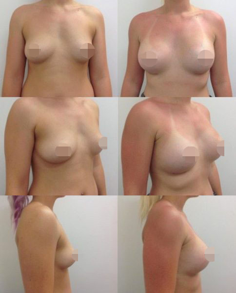 Breast Augmentation CosMediTour
