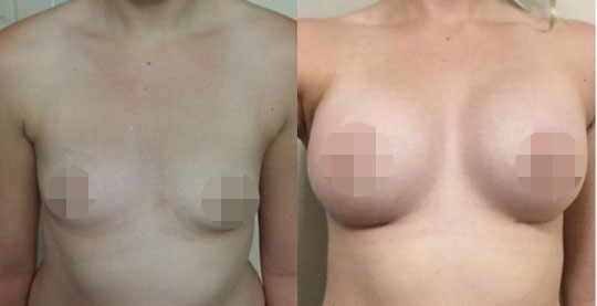 Bangkok Breast Augmentation!