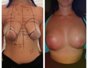Breast Lift + Augmentation - 300cc, High Profile, Round, Under the Muscle