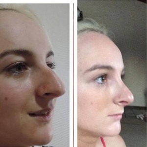 rhinoplasty-cosmeditour-before-after