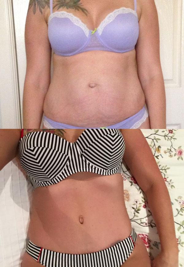 Bangkok Tummy Tuck + Liposuction Results!