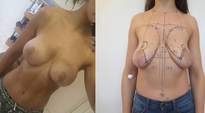 Breast Reduction with Augmentation Before & After #6
