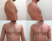 Male Breast Reduction
