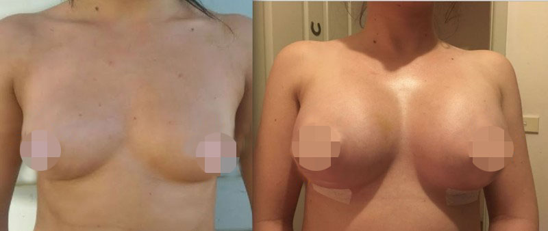 Breast Augmentation CosMediTour