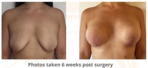 Breast-augmentation-lift-surgery2