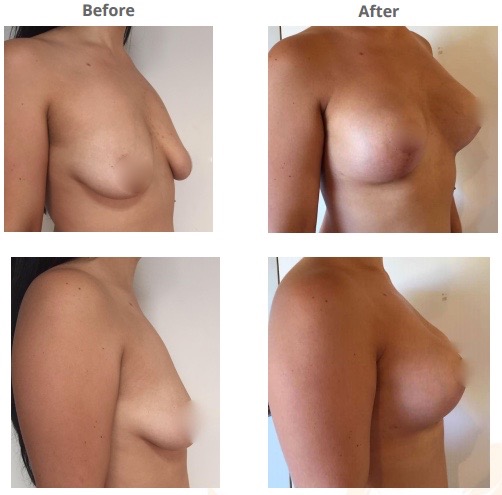 Breast Lift + Augmentation - R 300cc & L 275cc Round implant, Under the muscle, Lollipop Lift