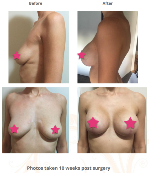 cosmeditour-breast-augmentation+lift