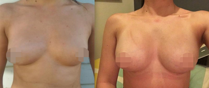 Breast Augmentation Before & After #327