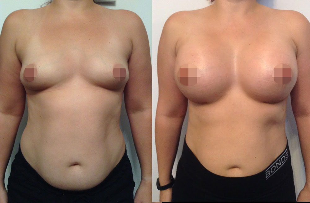 Breast Augmentation Before & After #329