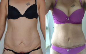 weightloss-befiore-after